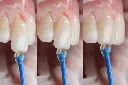 فينير (3).webp