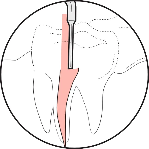 Illustration-Cutting-and-Condensing-Gutta-Percha-1.webp
