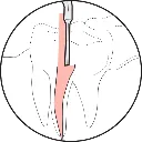 Illustration-Cutting-and-Condensing-Gutta-Percha-1.webp