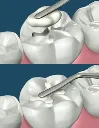 composite_filling1_1.webp