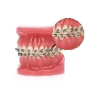 uu_ortho_anterior_root_torquing_spring_1.webp