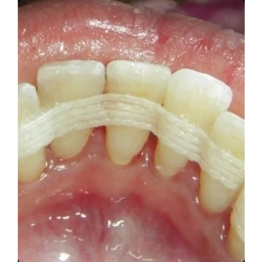 e_splint.webp