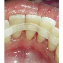 e_splint.webp