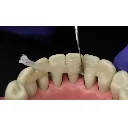 e_splint2.webp