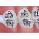 Buccal Tubes