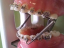 Dental Wires & Springs
