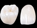 Composite Resin Crowns
