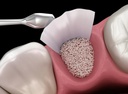Bones grafts and Membrane