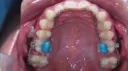 Bite Raising Composite